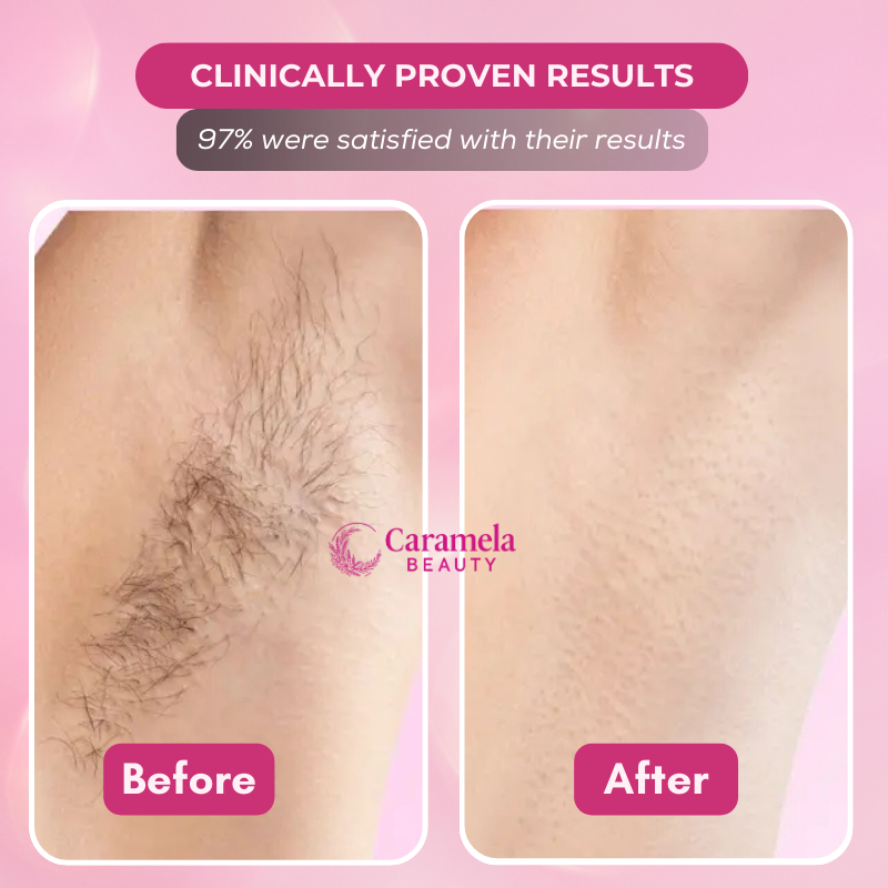 Caramela Beauty™ Cyperus Rotundus Oil for Natural Permanent Hair Reduction