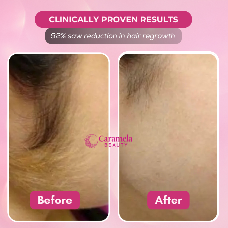 Caramela Beauty™ Cyperus Rotundus Oil for Natural Permanent Hair Reduction